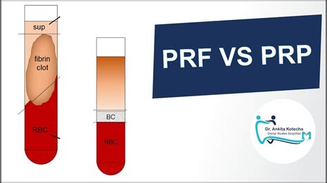 prf vs prp pubmed